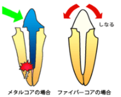 ファイバーコア（素材：レジン・ファイバー）
