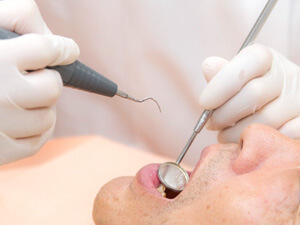 【スケーリング】定期的な施術で口腔内環境を清潔に保つ